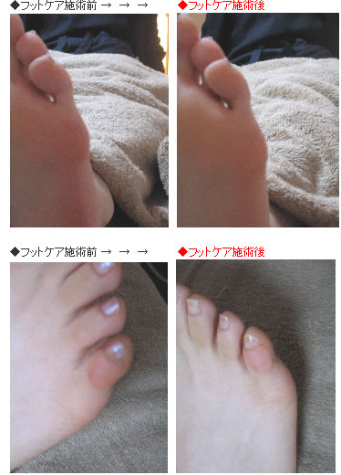 フスフレーゲ(フットケア)施術前後の変化