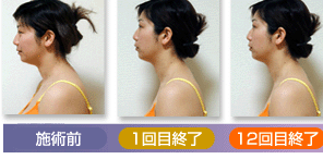 モンテセラピーの施術記録1